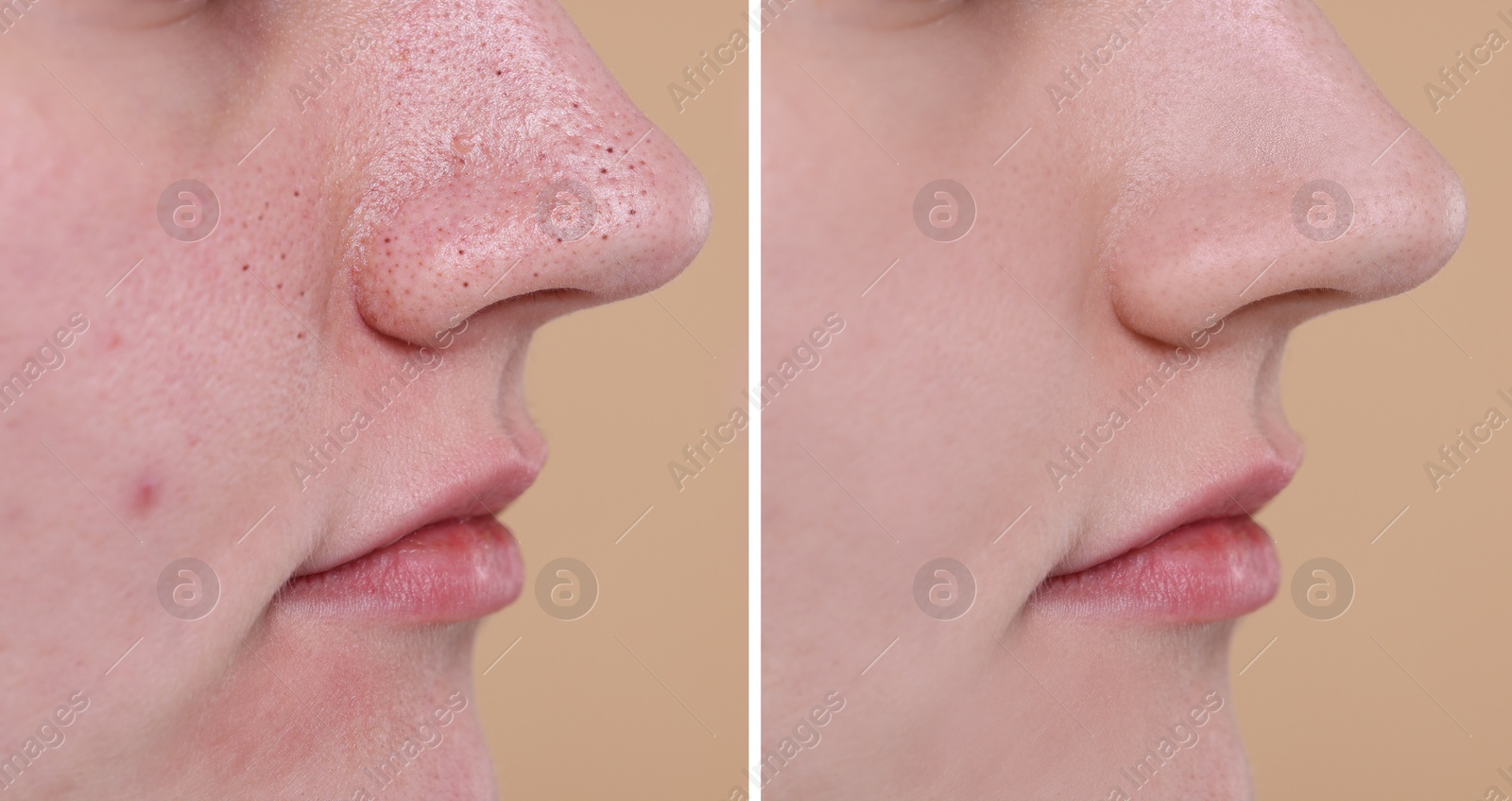 Image of Blackhead treatment, before and after. Collage with photos of woman on beige background, closeup view