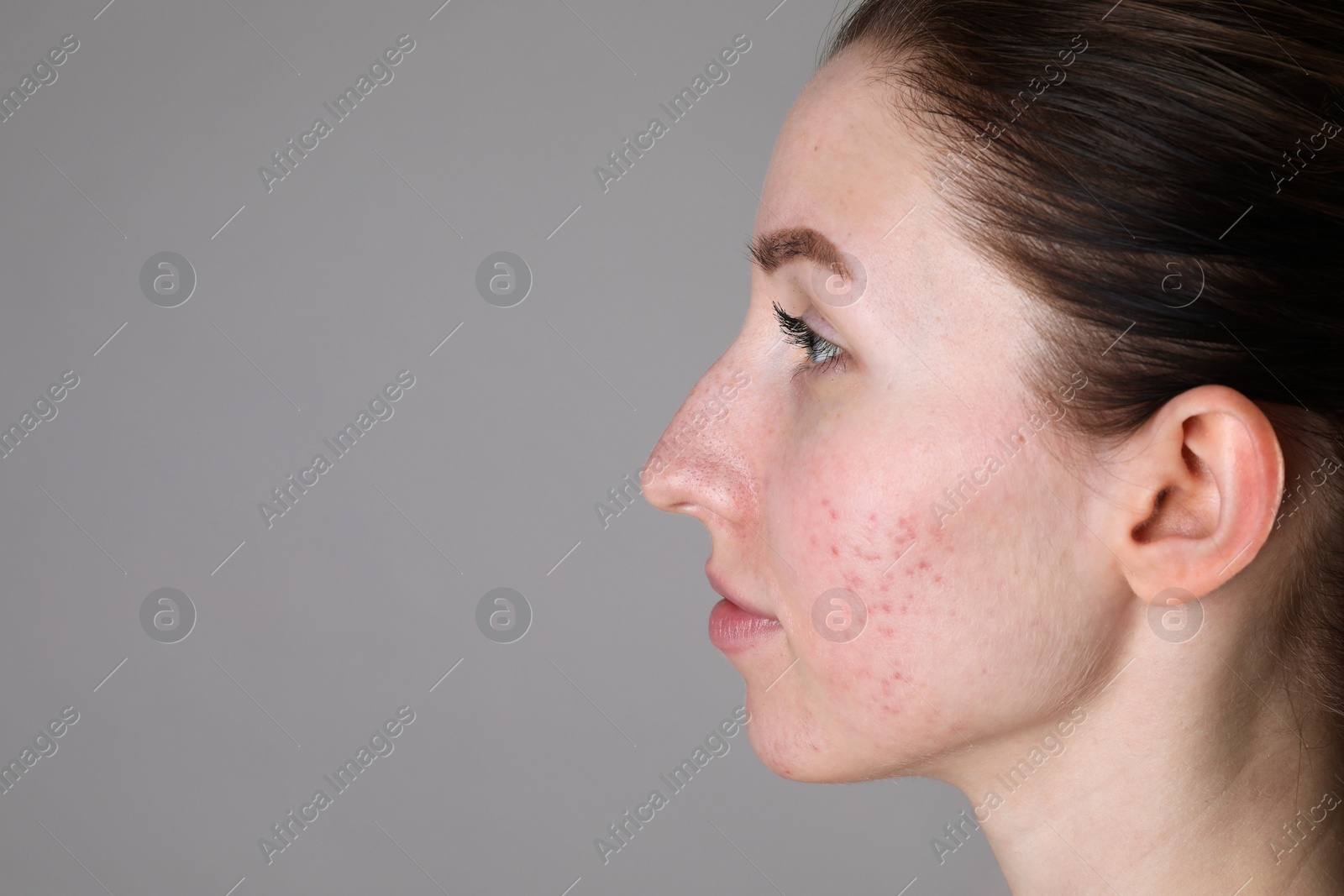 Photo of Young woman with acne problem on light grey background. Space for text