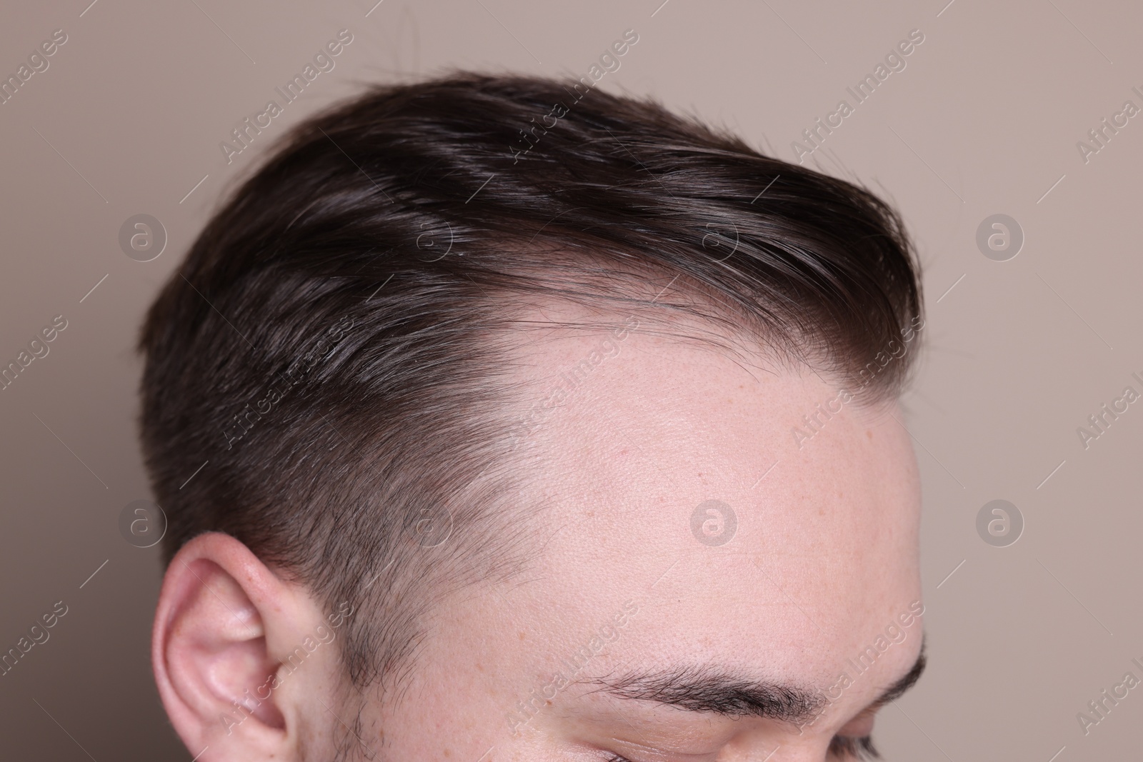 Photo of Baldness concept. Man with receding hairline on beige background, closeup