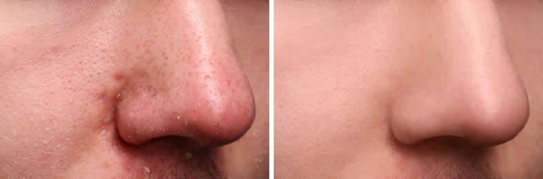 Image of Photos of man before and after acne treatment, closeup. Collage showing affected and healthy skin
