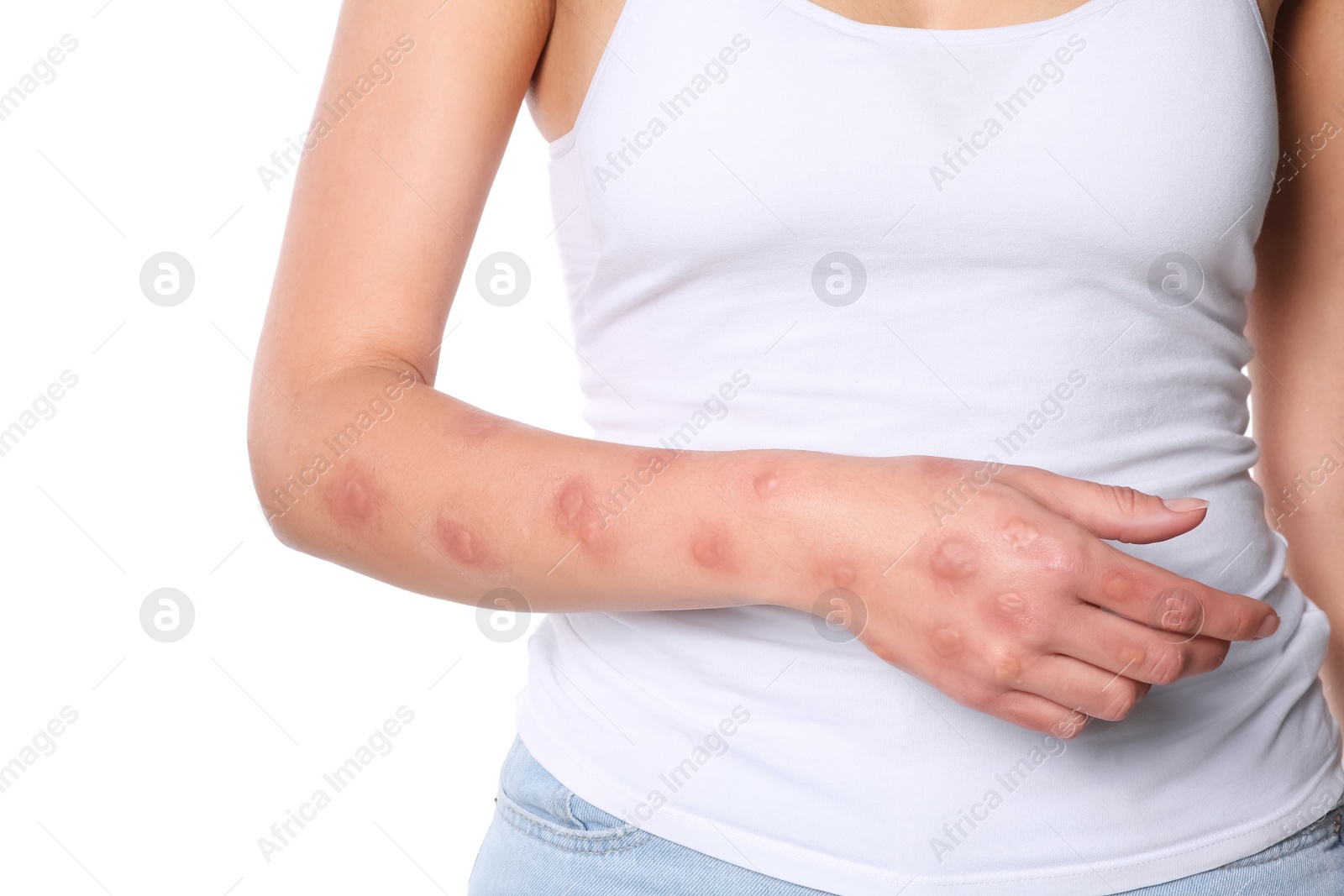 Photo of Woman with rash suffering from monkeypox virus on white background, closeup