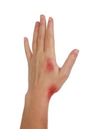 Woman with burned hand on white background, closeup