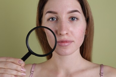 Young woman with acne problem holding magnifying glass near her skin on olive background, closeup