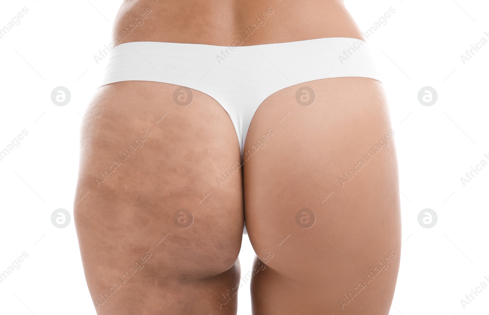 Image of Young woman in underwear before and after beauty procedure on white background, closeup. Body care