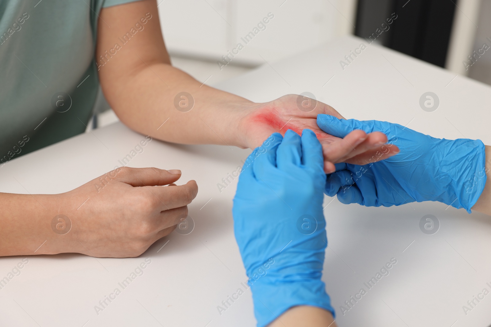 Photo of Doctor examining patient's burned hand indoors, closeup