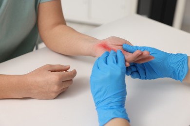 Photo of Doctor examining patient's burned hand indoors, closeup