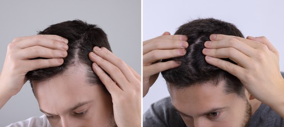 Man showing hair before and after dandruff treatment on grey background, collage