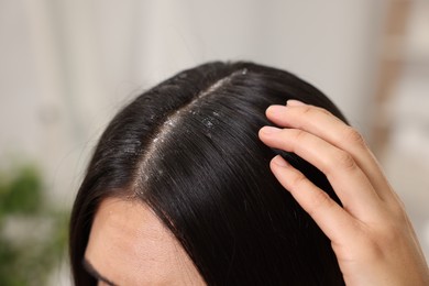 Photo of Woman examining her hair and scalp indoors, closeup. Dandruff problem