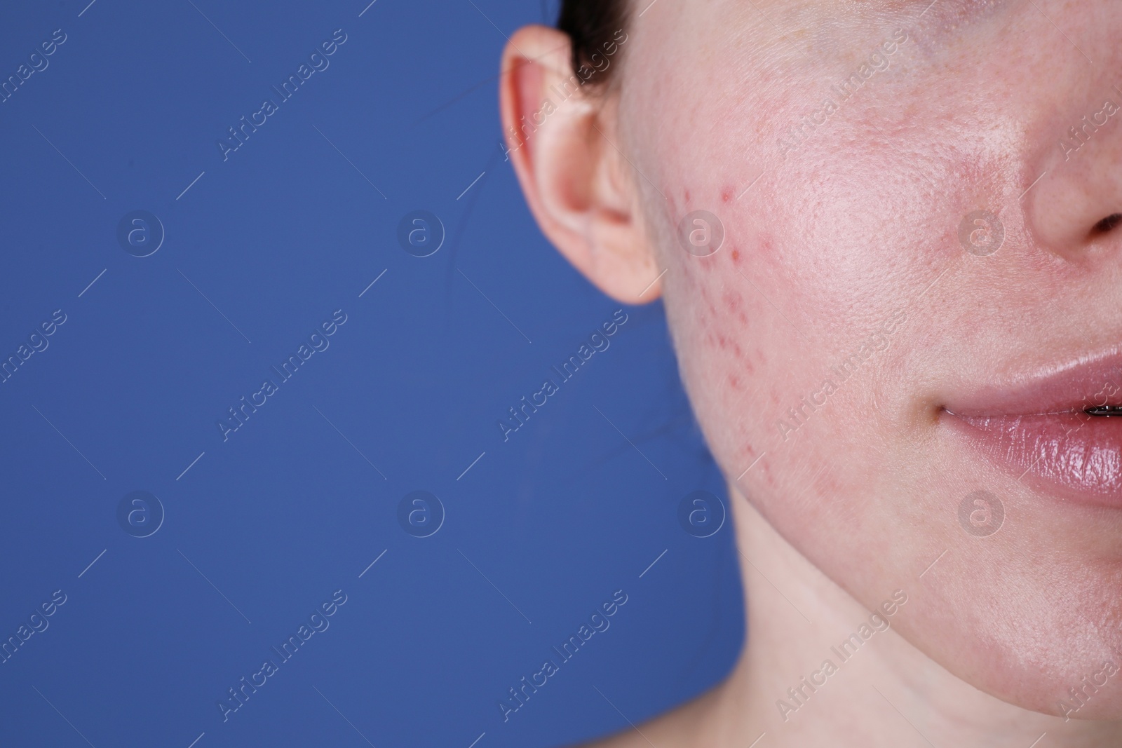 Photo of Young woman with acne problem on blue background, closeup. Space for text