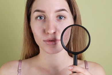 Young woman with acne problem holding magnifying glass near her skin on olive background, closeup