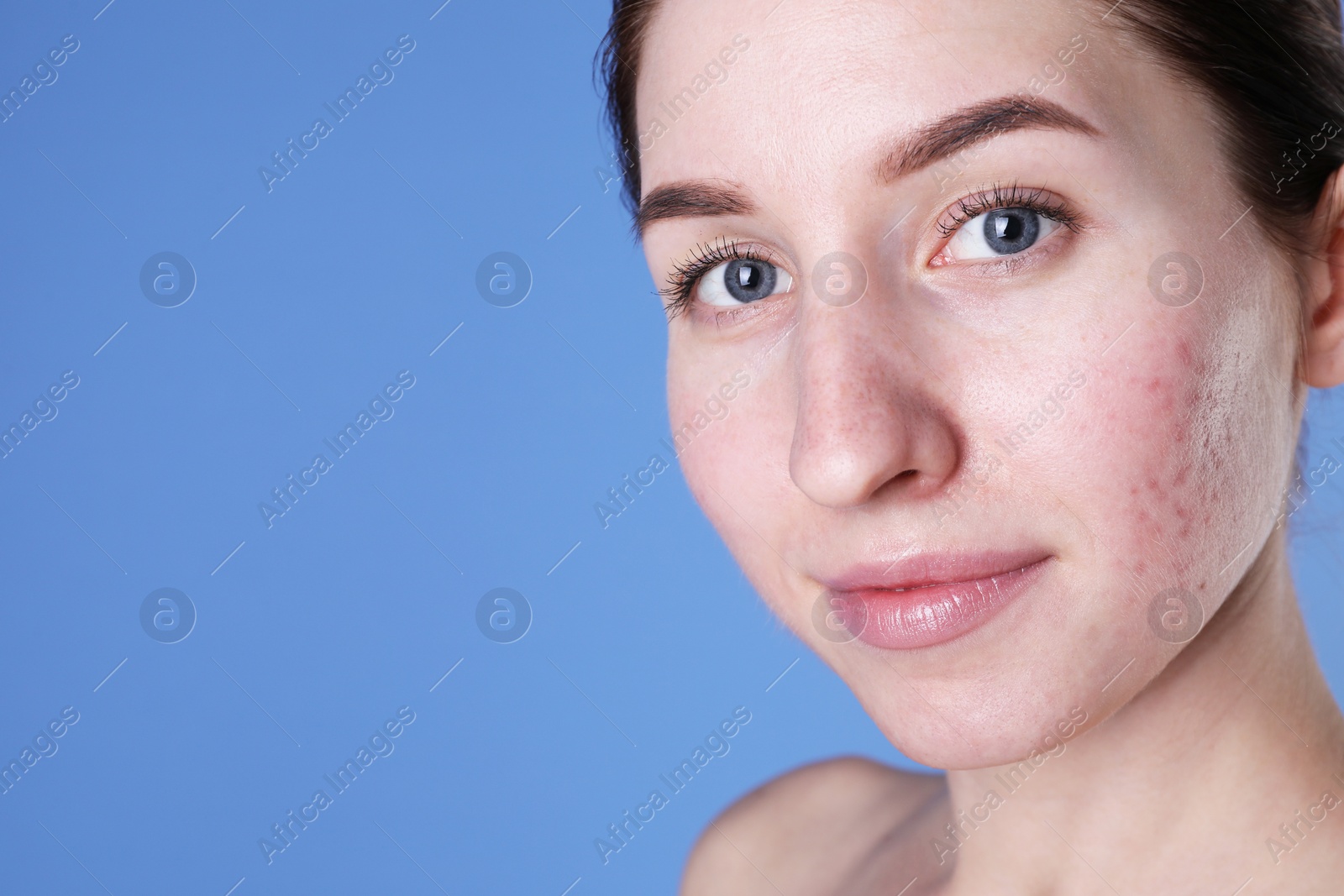 Photo of Young woman with acne problem on blue background, closeup. Space for text