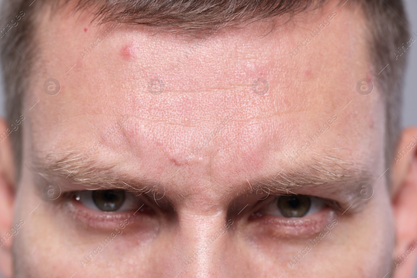 Photo of Closeup view of man with wrinkles on his forehead