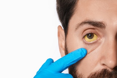 Photo of Doctor checking man with yellow eyes on white background, closeup. Symptom of hepatitis