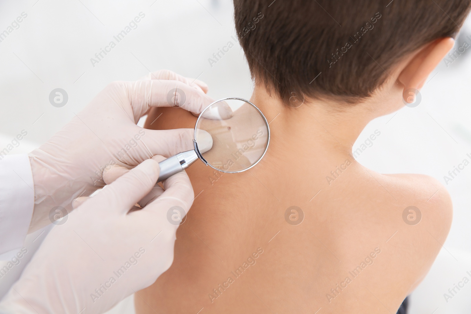 Photo of Dermatologist examining little boy's birthmark with magnifying glass in clinic, closeup