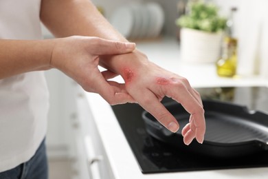 Photo of Woman with burns on her hand in kitchen, closeup