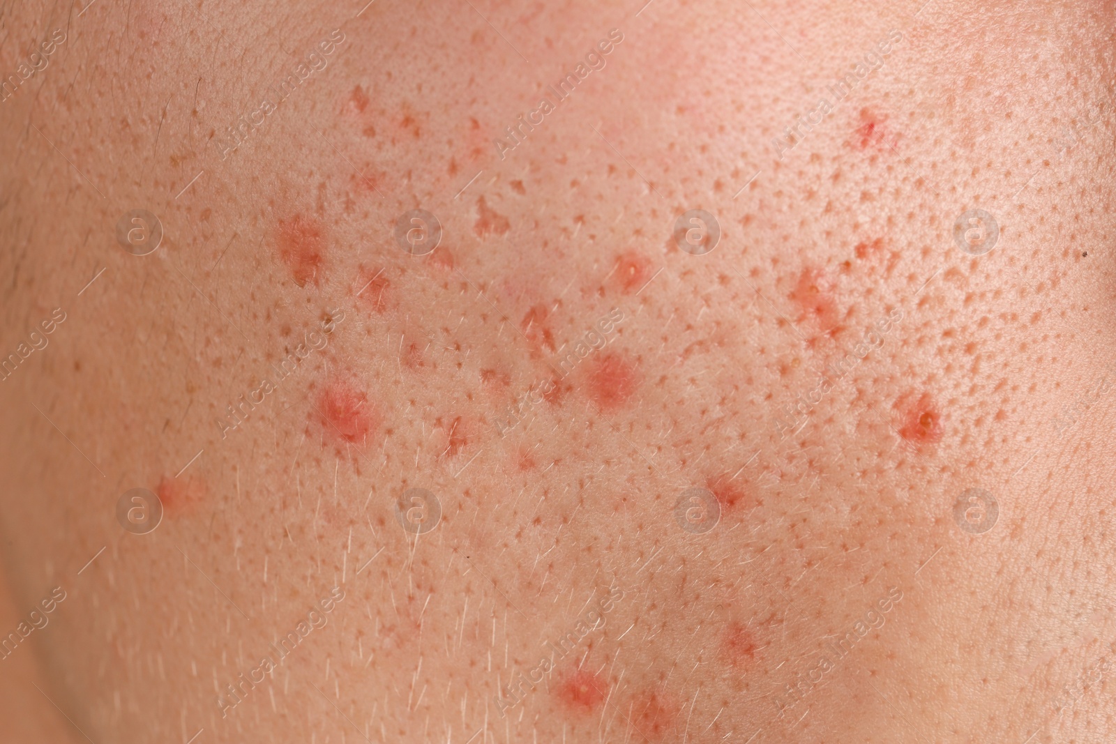 Photo of Young person with acne problem, closeup of cheek