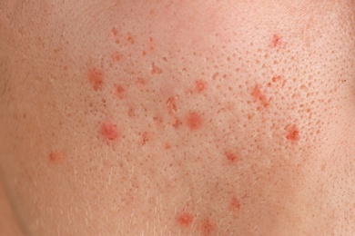 Young person with acne problem, closeup of cheek