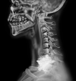 Illustration of  X-ray of patient with cancer. Illustration