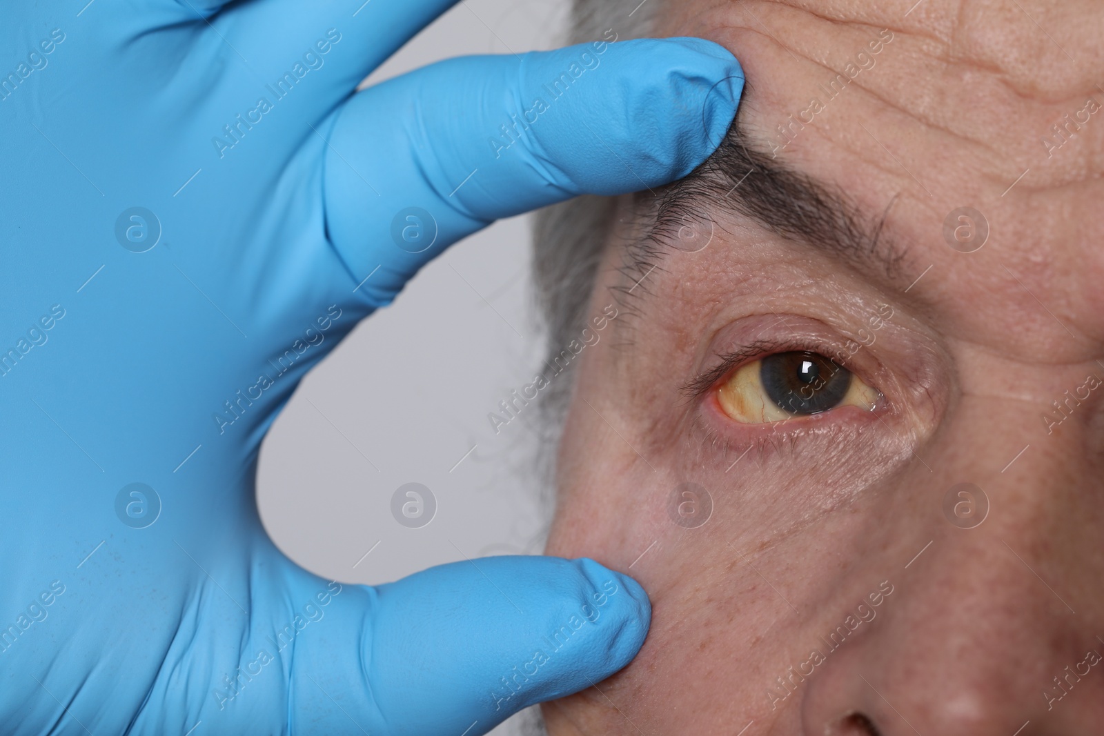 Photo of Doctor checking man with yellow eyes on light background, closeup. Symptom of hepatitis