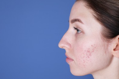 Young woman with acne problem on blue background, closeup. Space for text