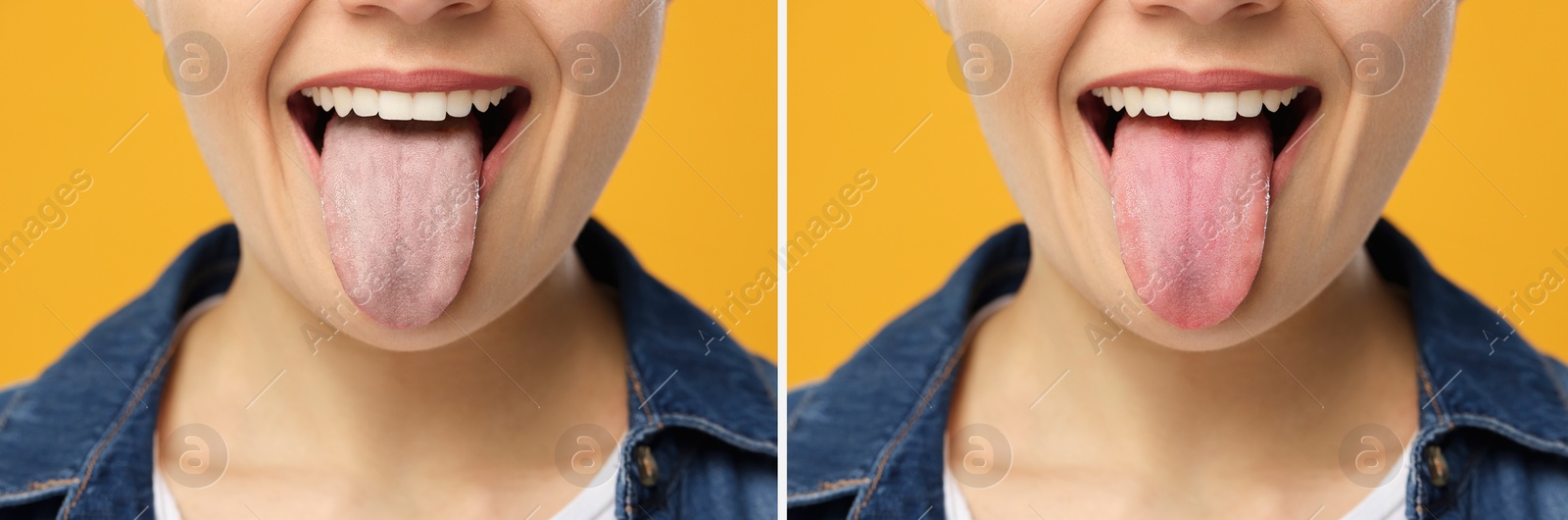 Image of Collage with photos of woman before and after tongue cleaning on yellow background, closeup