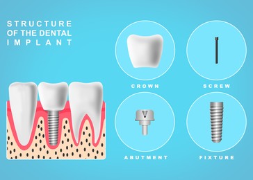 Image of Structure of dental implant on turquoise background, illustration. Educational poster