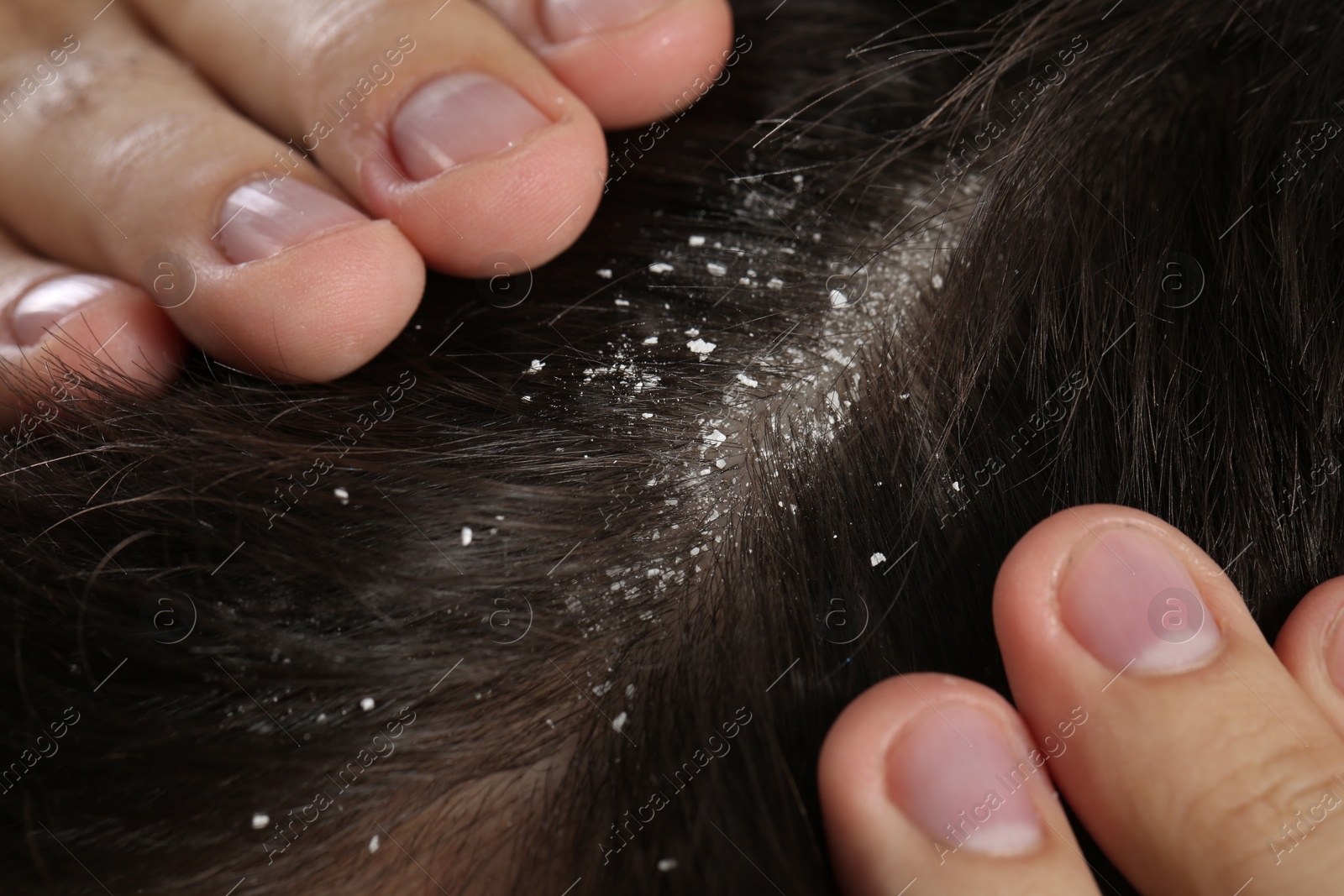 Photo of Man with dandruff in his dark hair, macro view