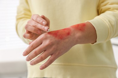 Photo of Woman applying healing cream onto burned hand indoors, closeup