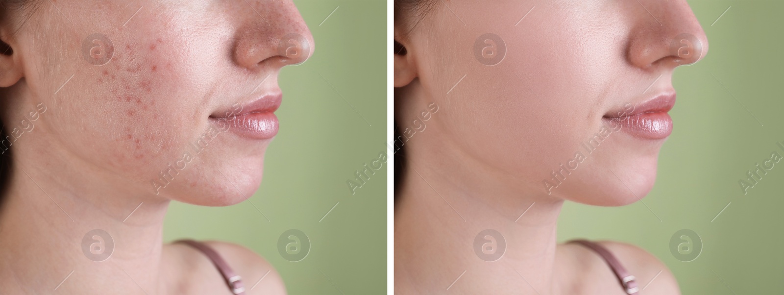 Image of Acne problem. Young woman before and after treatment on green background, closeup. Collage of photos