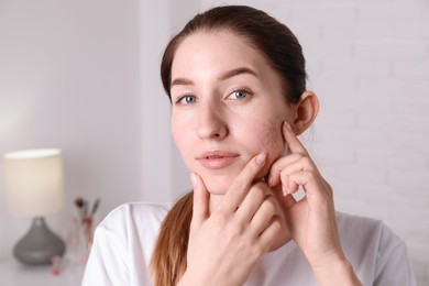 Photo of Young woman with acne problem at home