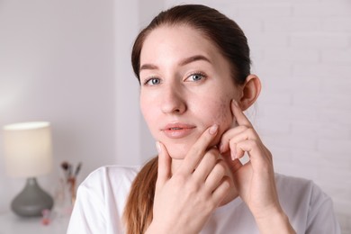 Young woman with acne problem at home