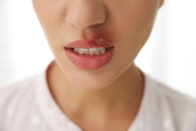 Photo of Woman with herpes on lip against light background, closeup