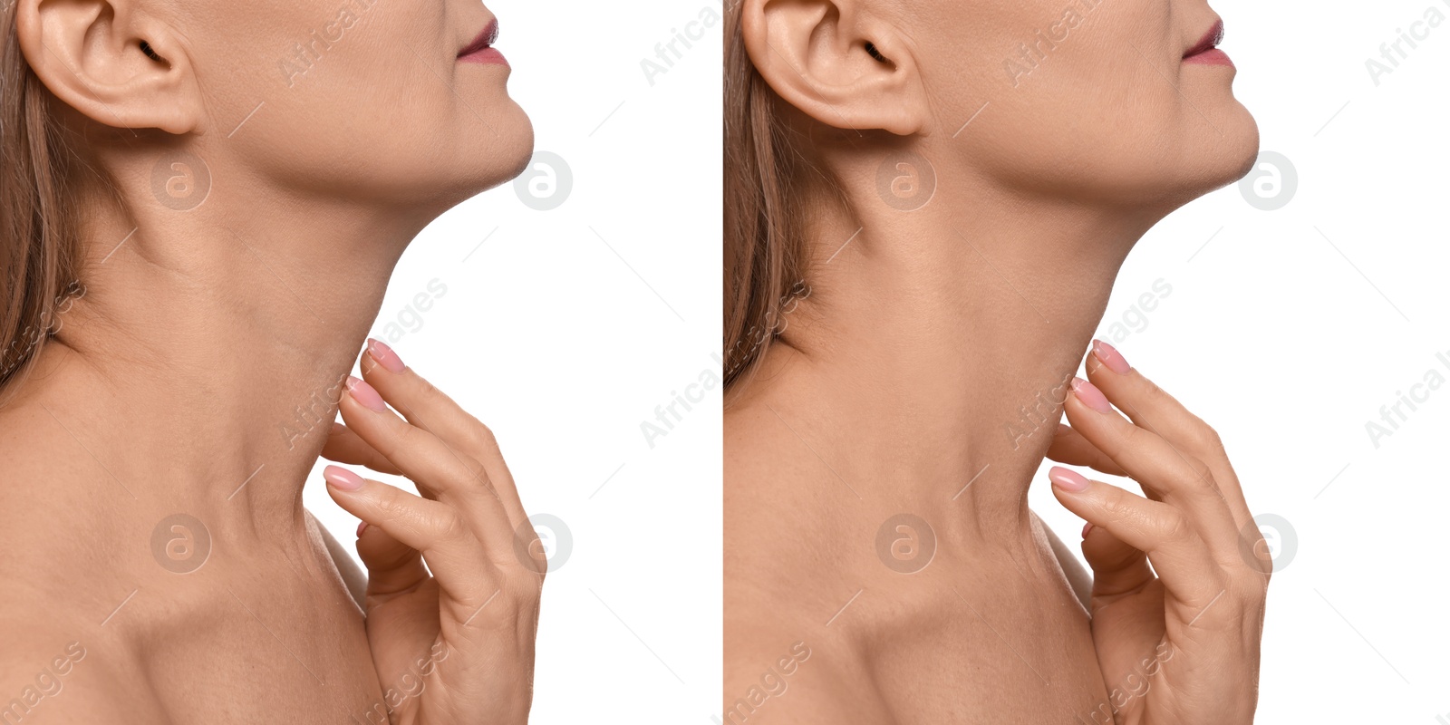 Image of Collage with photos of woman before and after cosmetic procedure on white background, closeup