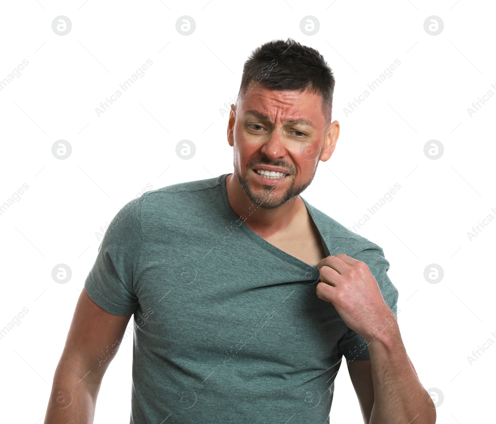 Photo of Man with sunburned skin on white background