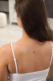 Woman`s body with birthmarks indoors, back view
