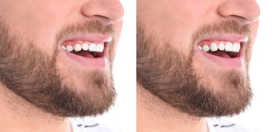 Image of Young man before and after gingivoplasty procedure on white background, closeup. Banner design