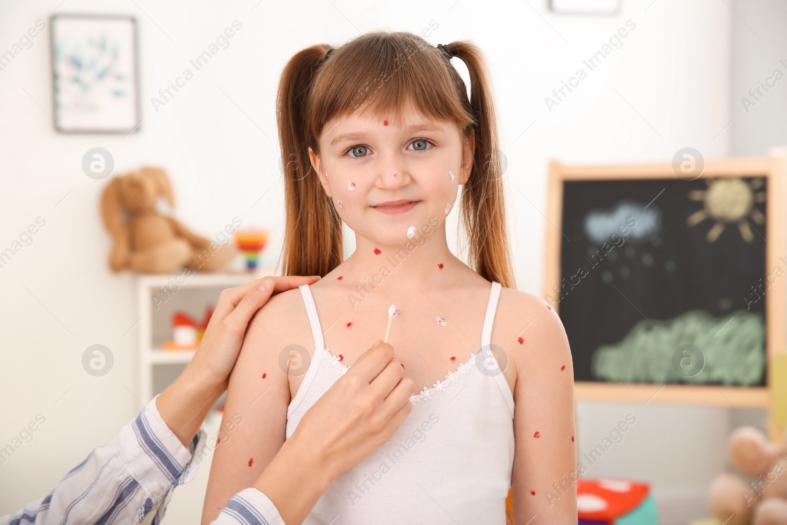 Photo of Woman applying cream onto skin of little girl with chickenpox at home