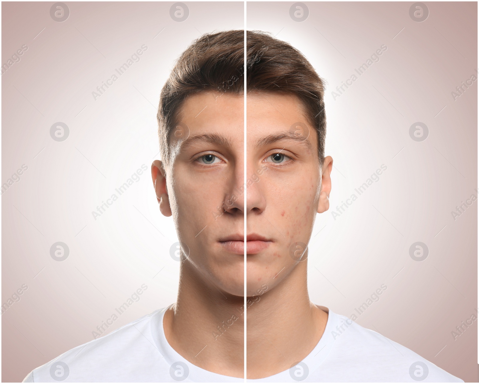 Image of Teen guy with acne problem before and after treatment on light background, collage