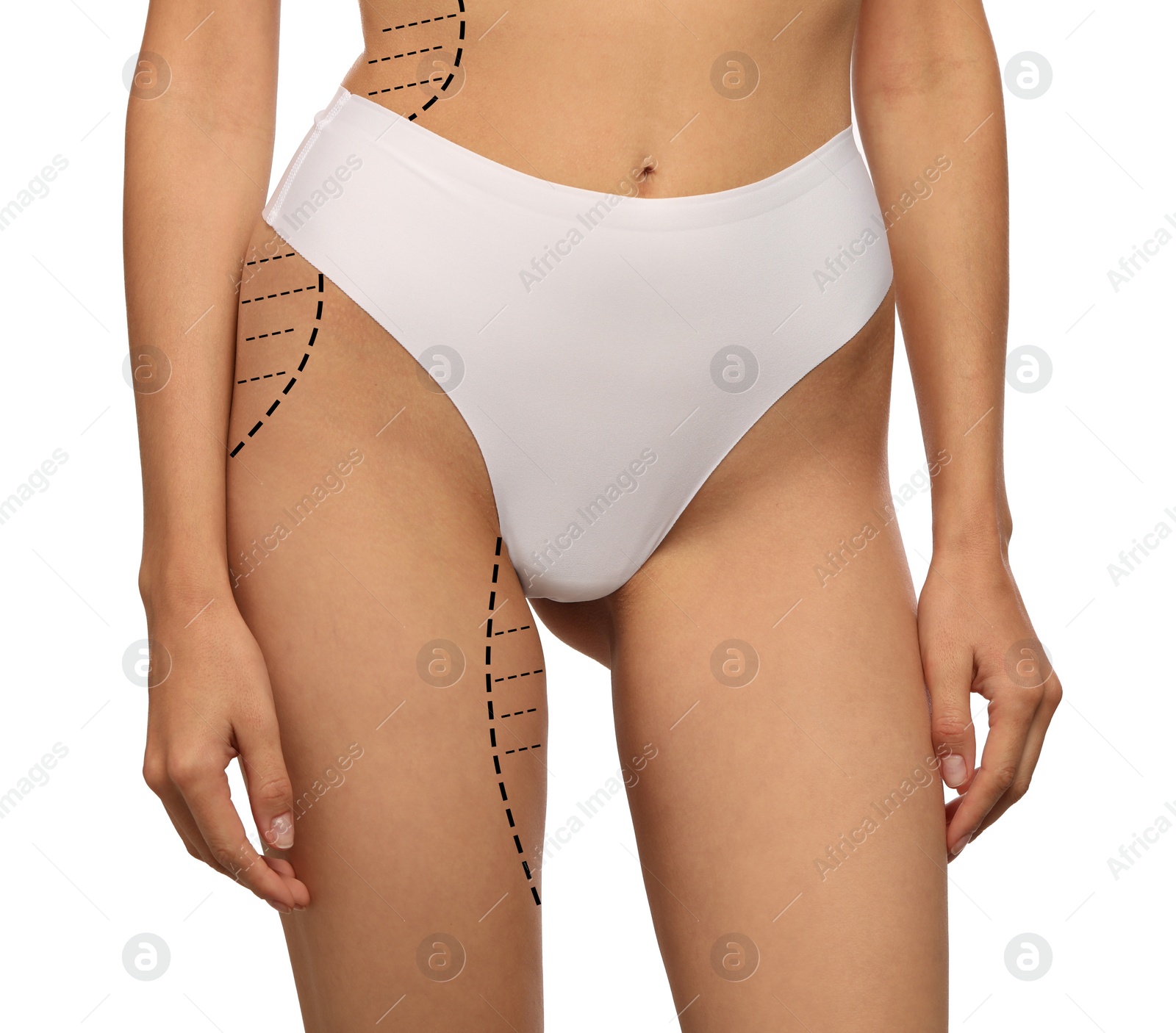 Image of Woman with markings for cosmetic surgery on her abdomen against white background, closeup