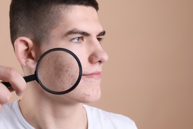 Young man with acne problem holding magnifying glass on beige background. Space for text