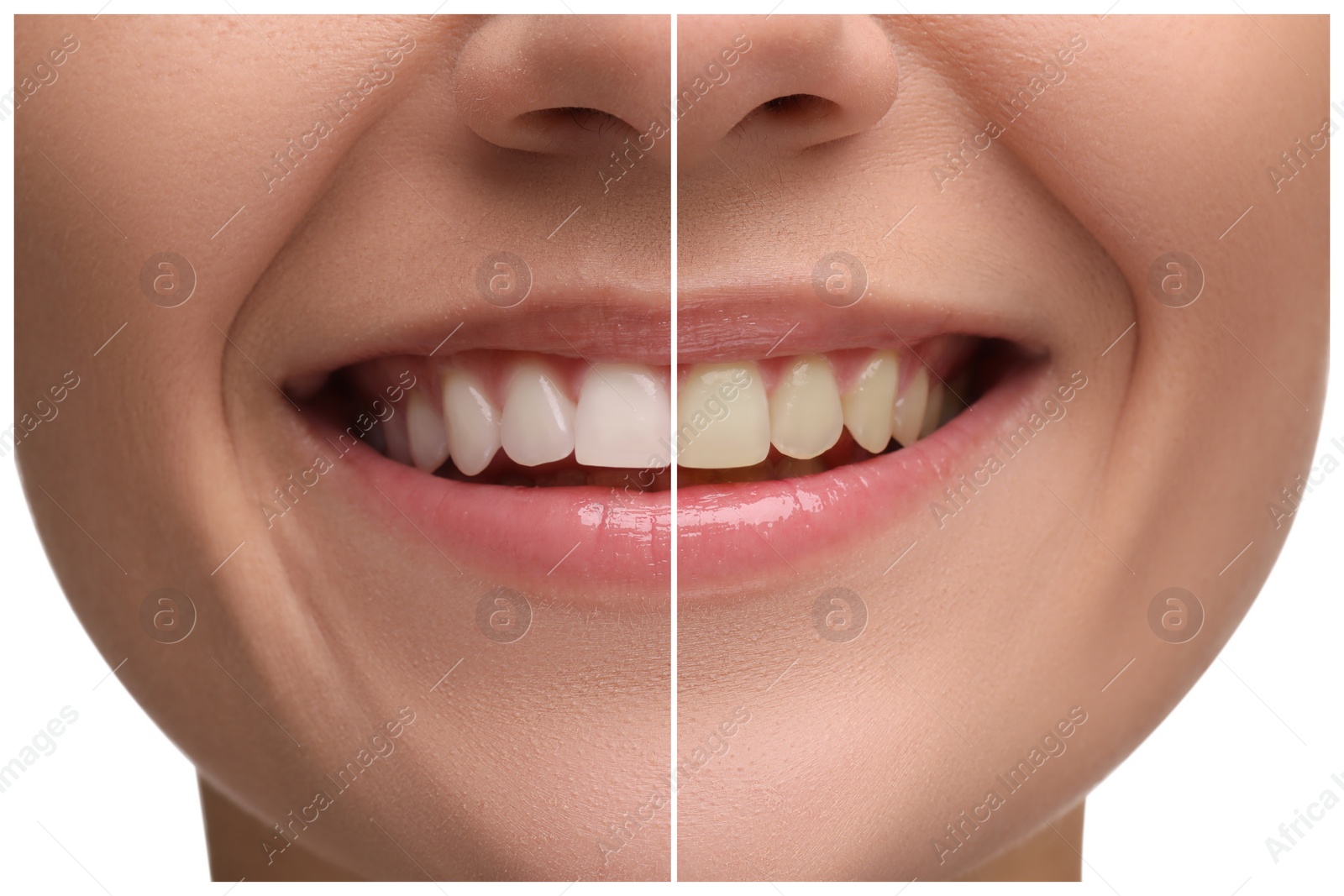 Image of Woman showing teeth before and after whitening on white background, collage