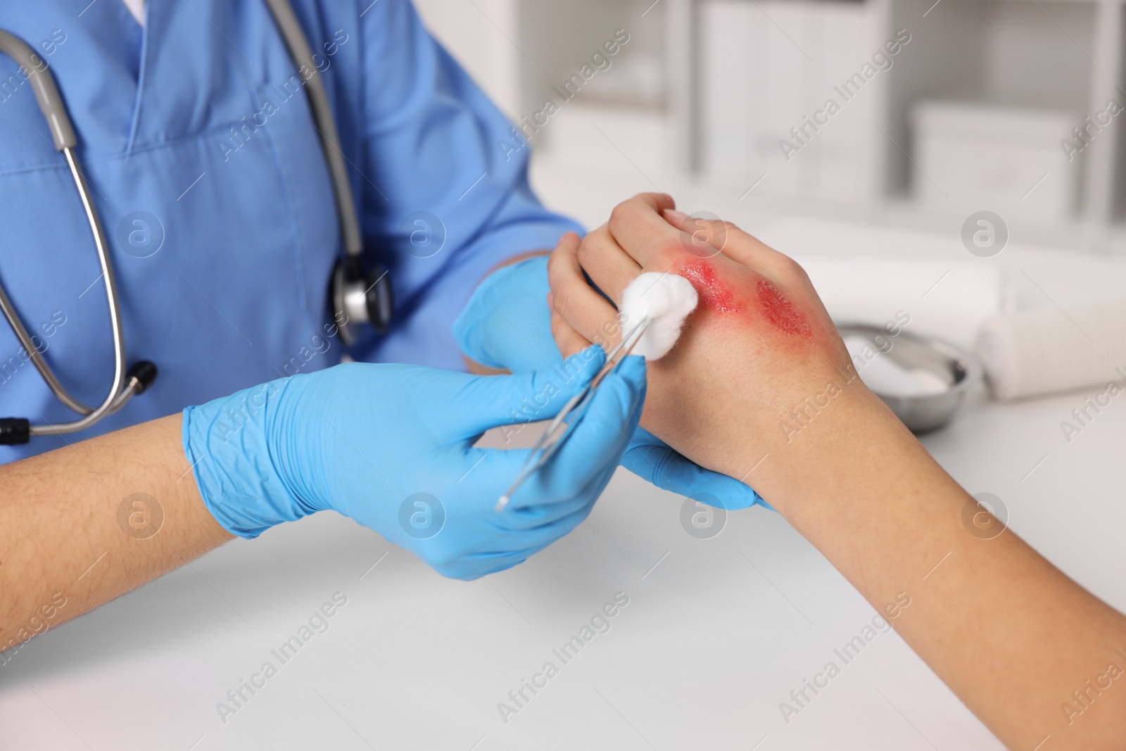 Photo of Doctor treating patient's burned hand at table, closeup