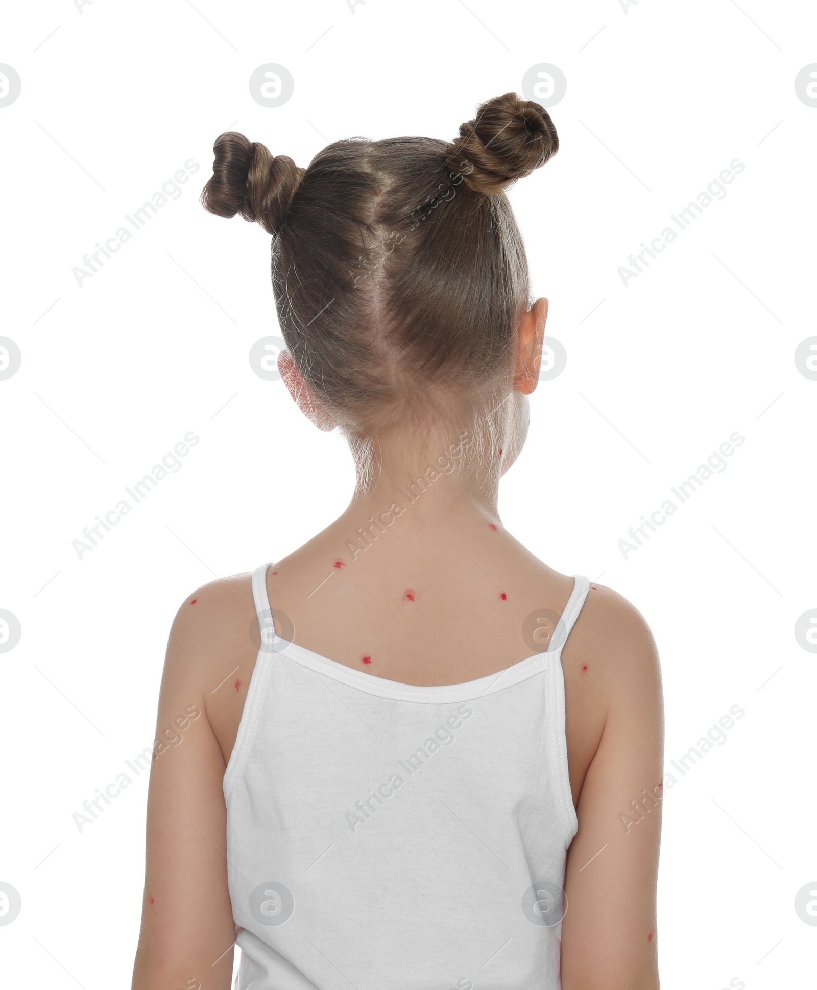 Photo of Little girl with chickenpox on white background. Varicella zoster virus