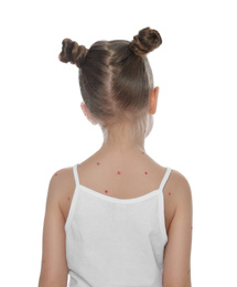 Photo of Little girl with chickenpox on white background. Varicella zoster virus