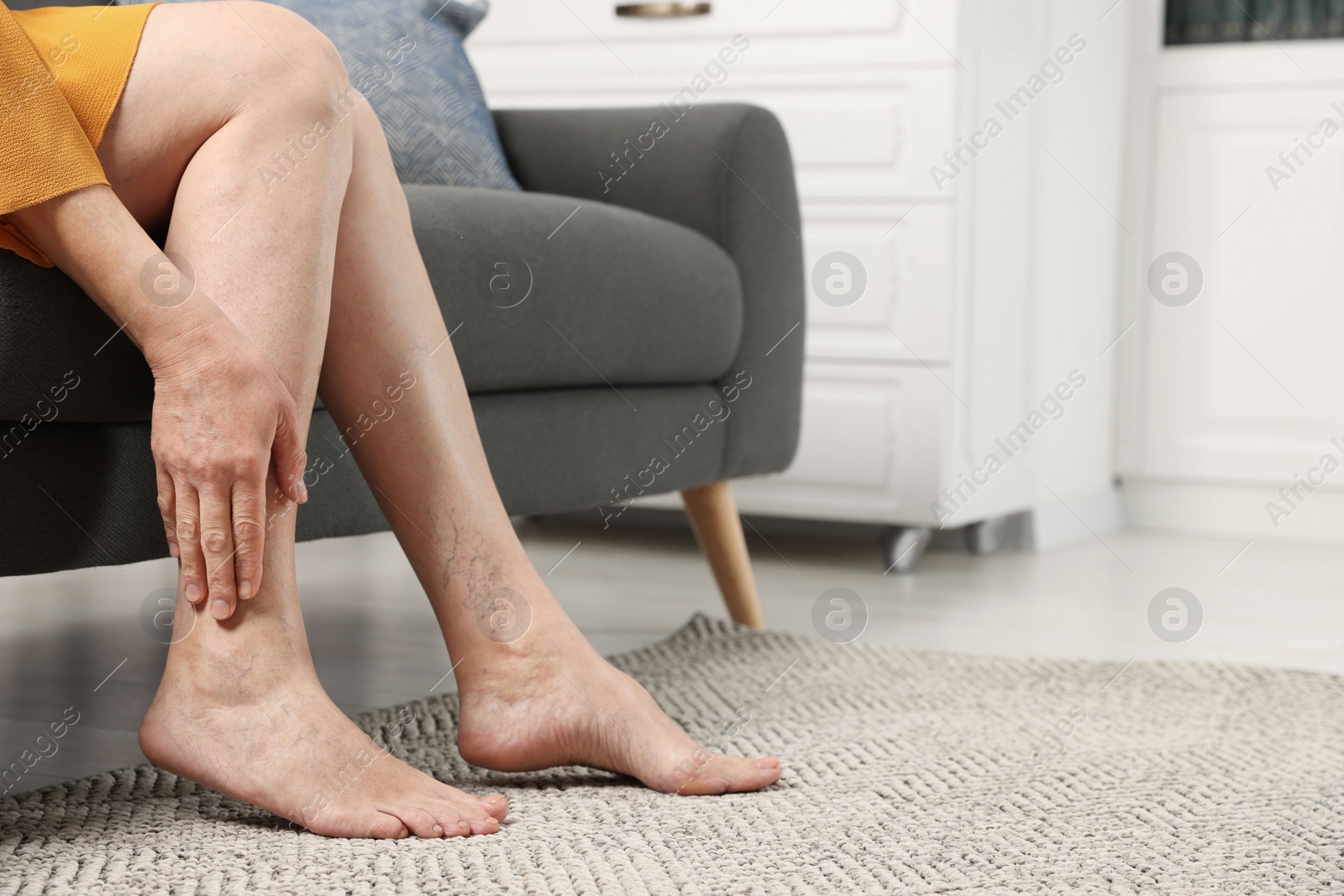 Photo of Barefoot woman with varicose veins on sofa in room, closeup