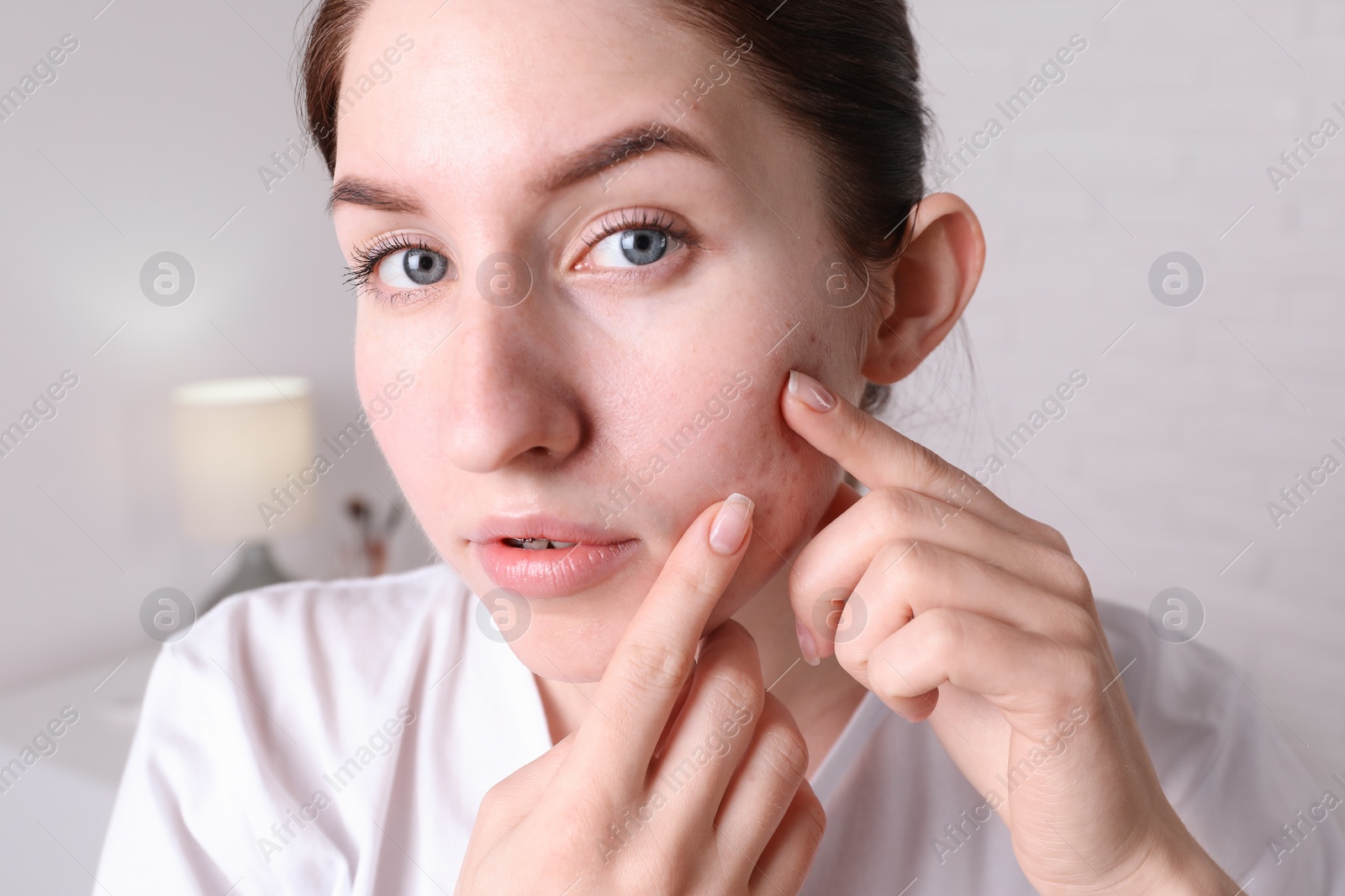 Photo of Young woman with acne problem at home