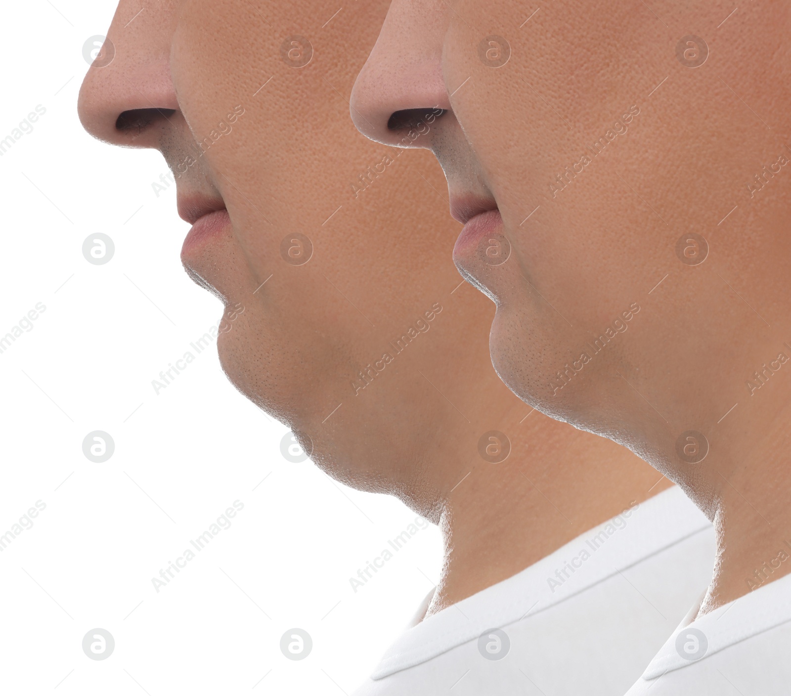 Image of Mature man before and after plastic surgery operation on white background, closeup. Double chin problem