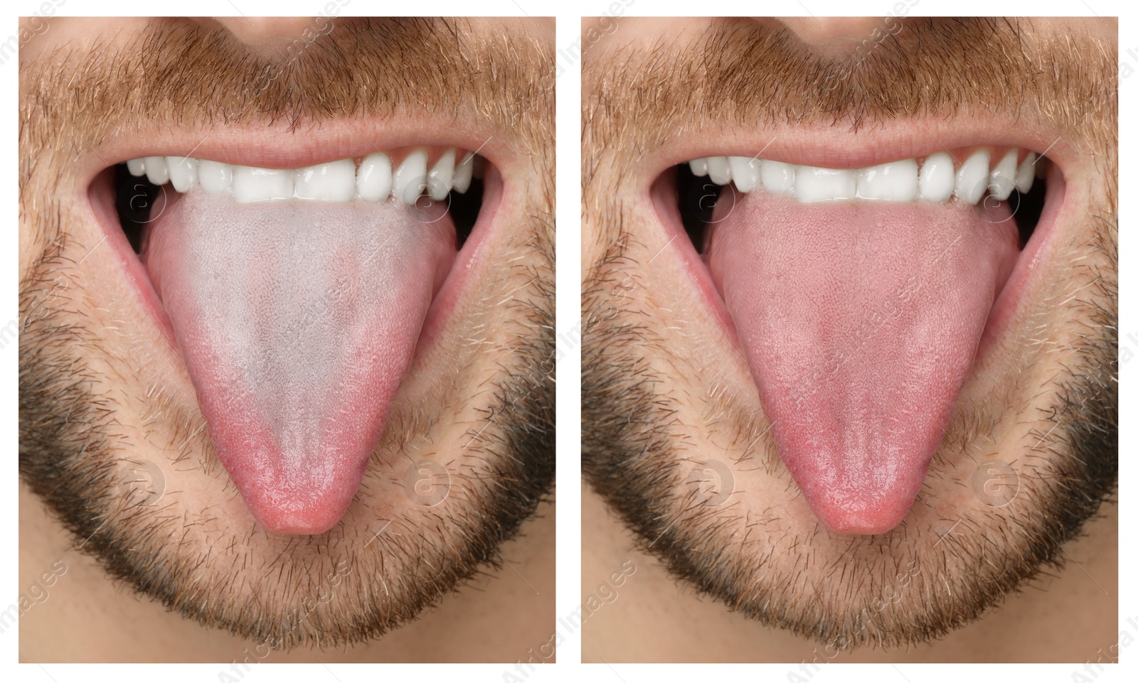 Image of Collage with photos of man before and after tongue cleaning, closeup