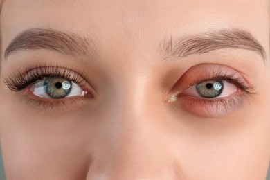 Image of Woman with inflamed eye suffering from conjunctivitis, closeup