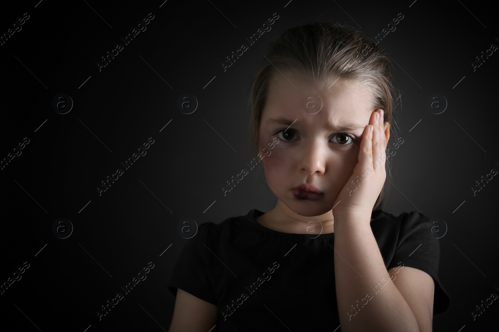 Photo of Little girl with bruises on face against dark background, space for text. Domestic violence victim